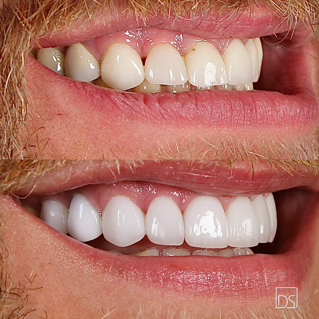 Smile Gallery - Before and After Result Image 19 by Daniel C. Sluyk, DDS
