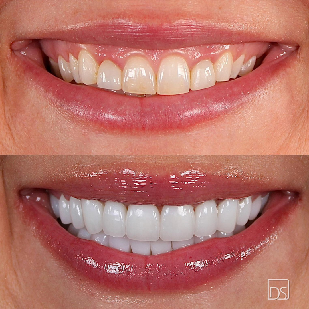 Smile Gallery - Before and After Result Image 20 by Daniel C. Sluyk, DDS