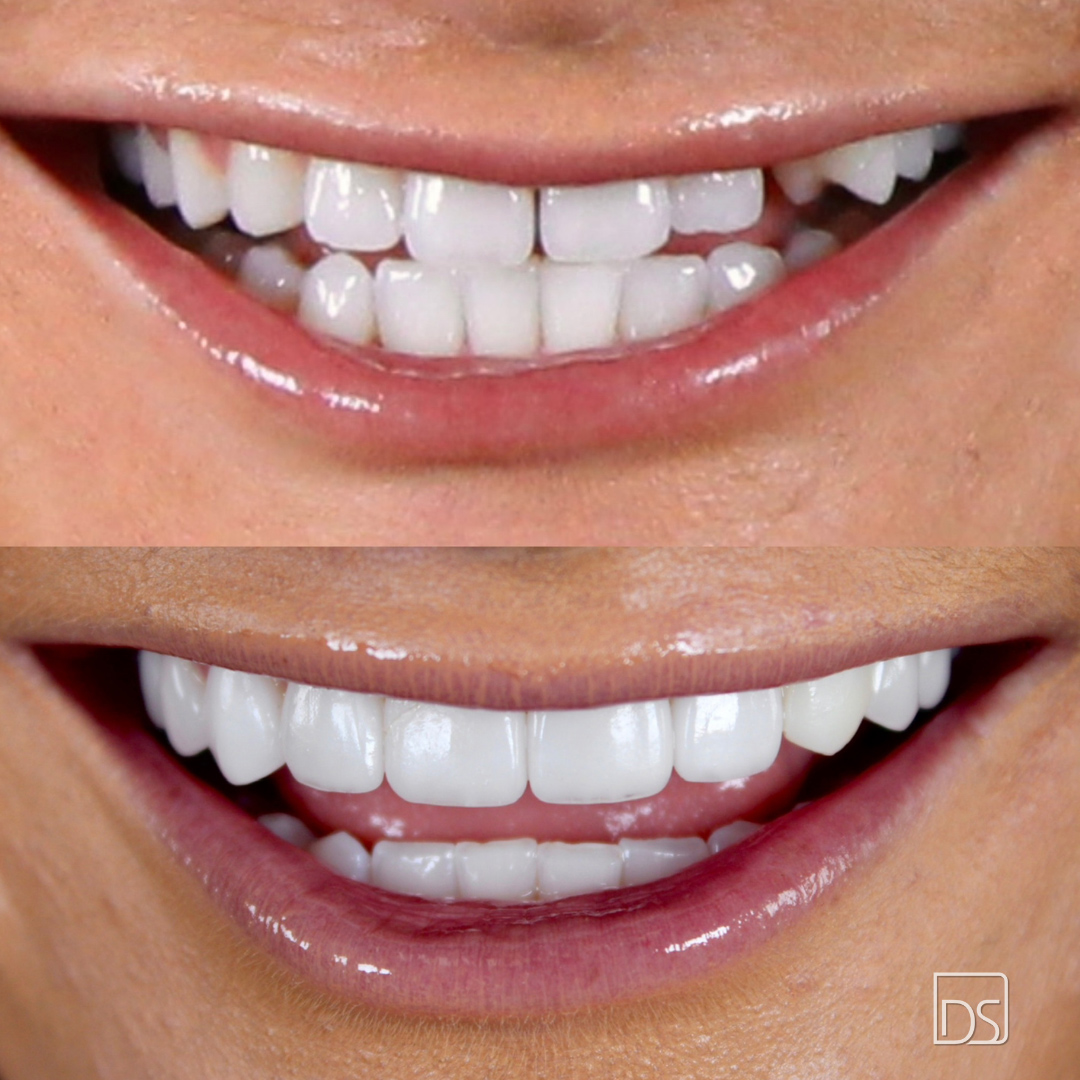 Smile Gallery - Before and After Result Image 23 by Daniel C. Sluyk, DDS