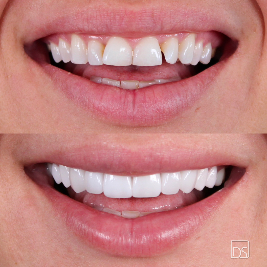 Smile Gallery - Before and After Result Image 24 by Daniel C. Sluyk, DDS