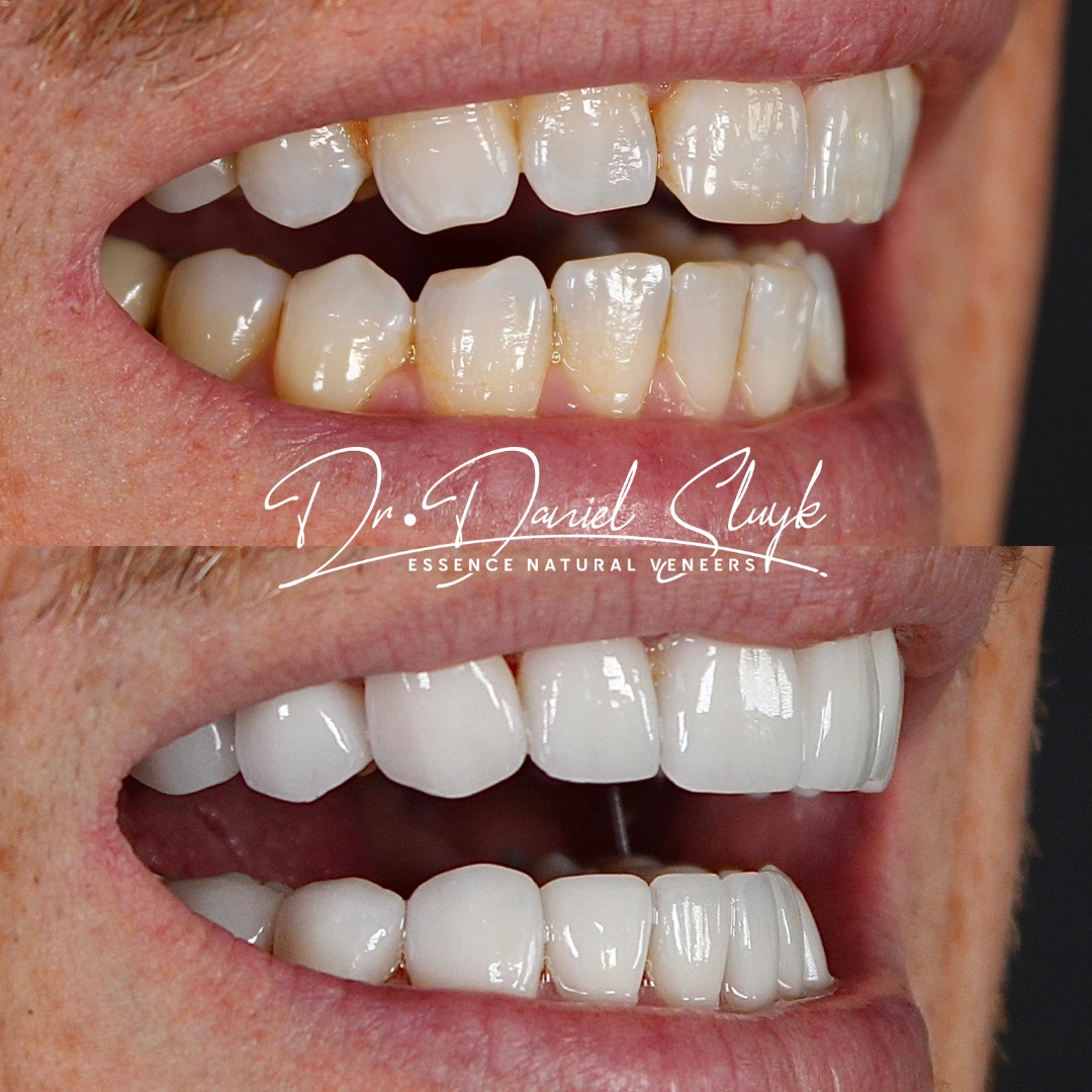 Smile Gallery - Before and After Result Image 11 by Daniel C. Sluyk, DDS