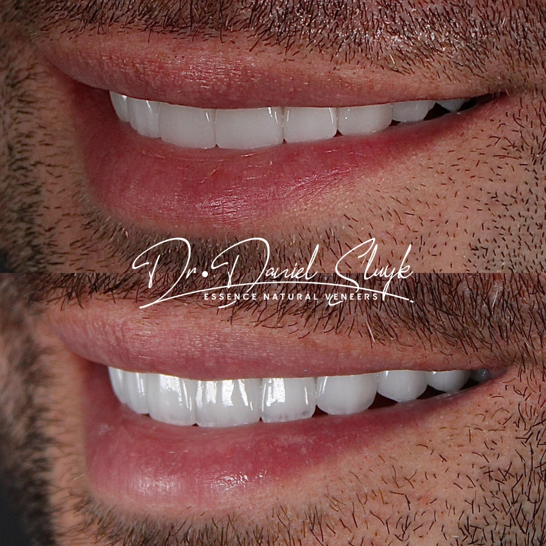 Smile Gallery - Before and After Result Image 10 by Daniel C. Sluyk, DDS