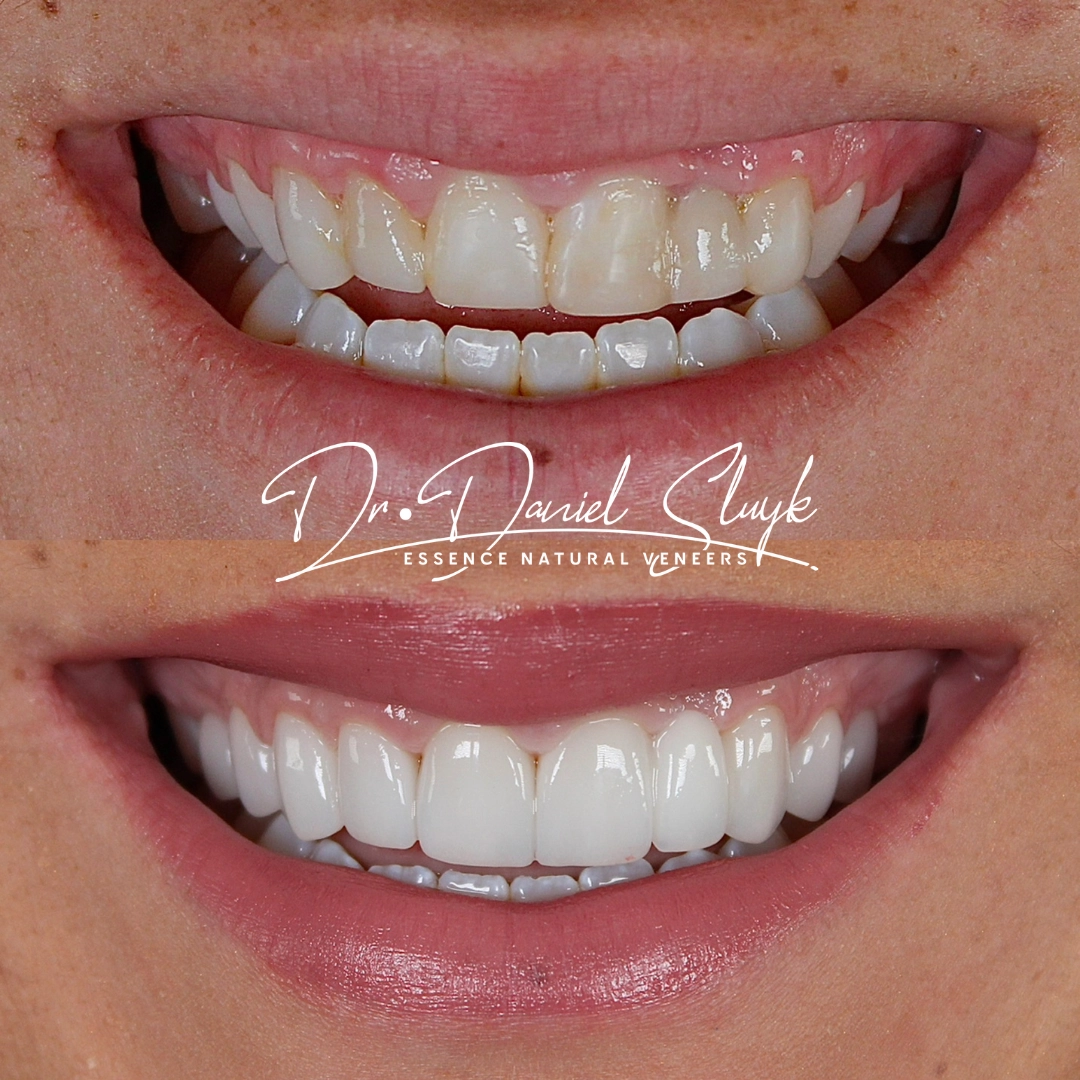 Smile Gallery - Before and After Result Image 9 by Daniel C. Sluyk, DDS