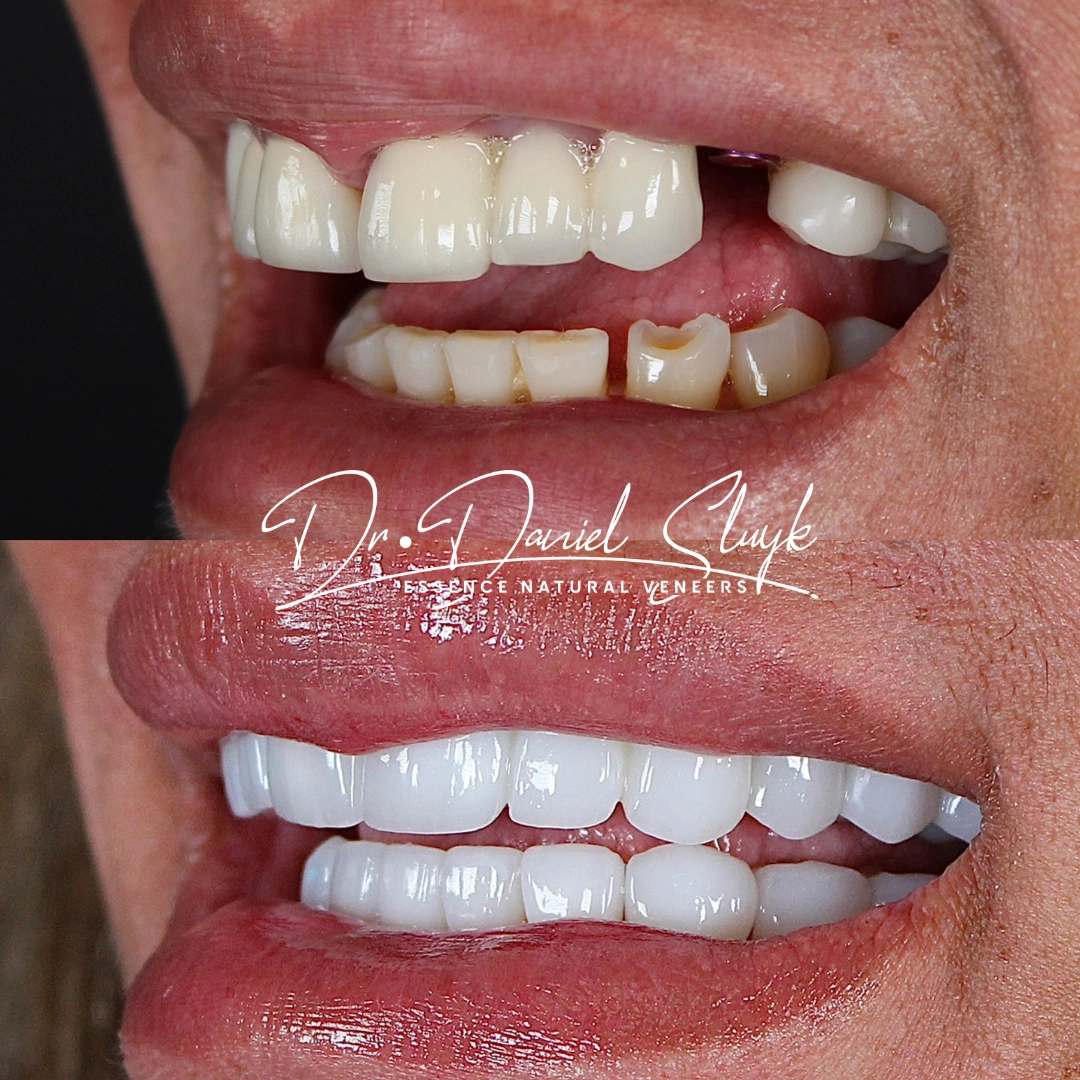 Smile Gallery - Before and After Result Image 12 by Daniel C. Sluyk, DDS