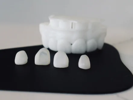 Porcelain veneer samples beside a dental mold cosmetic dentistry at DS Family And Cosmetic Dentistry